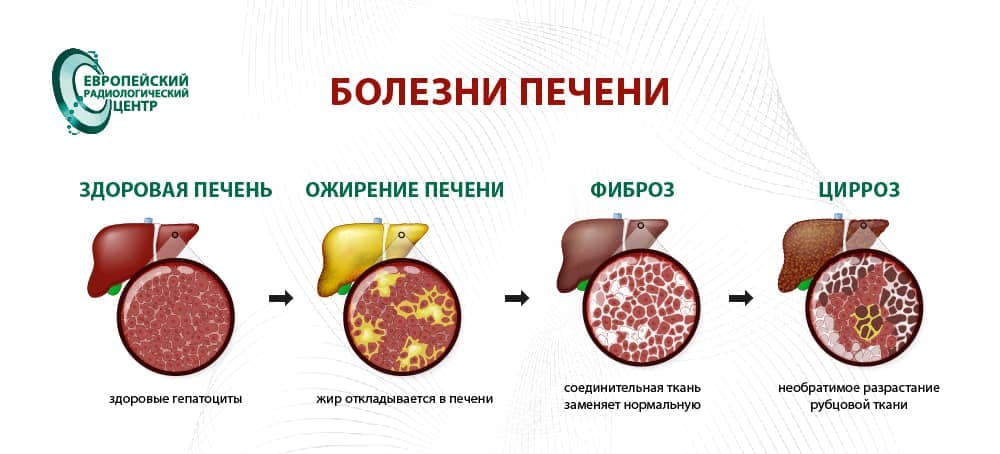 Заболевания печени — новости ЕРЦ